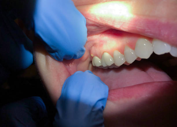 Best Emergency Gum Treatment in Sulphur Springs, AR